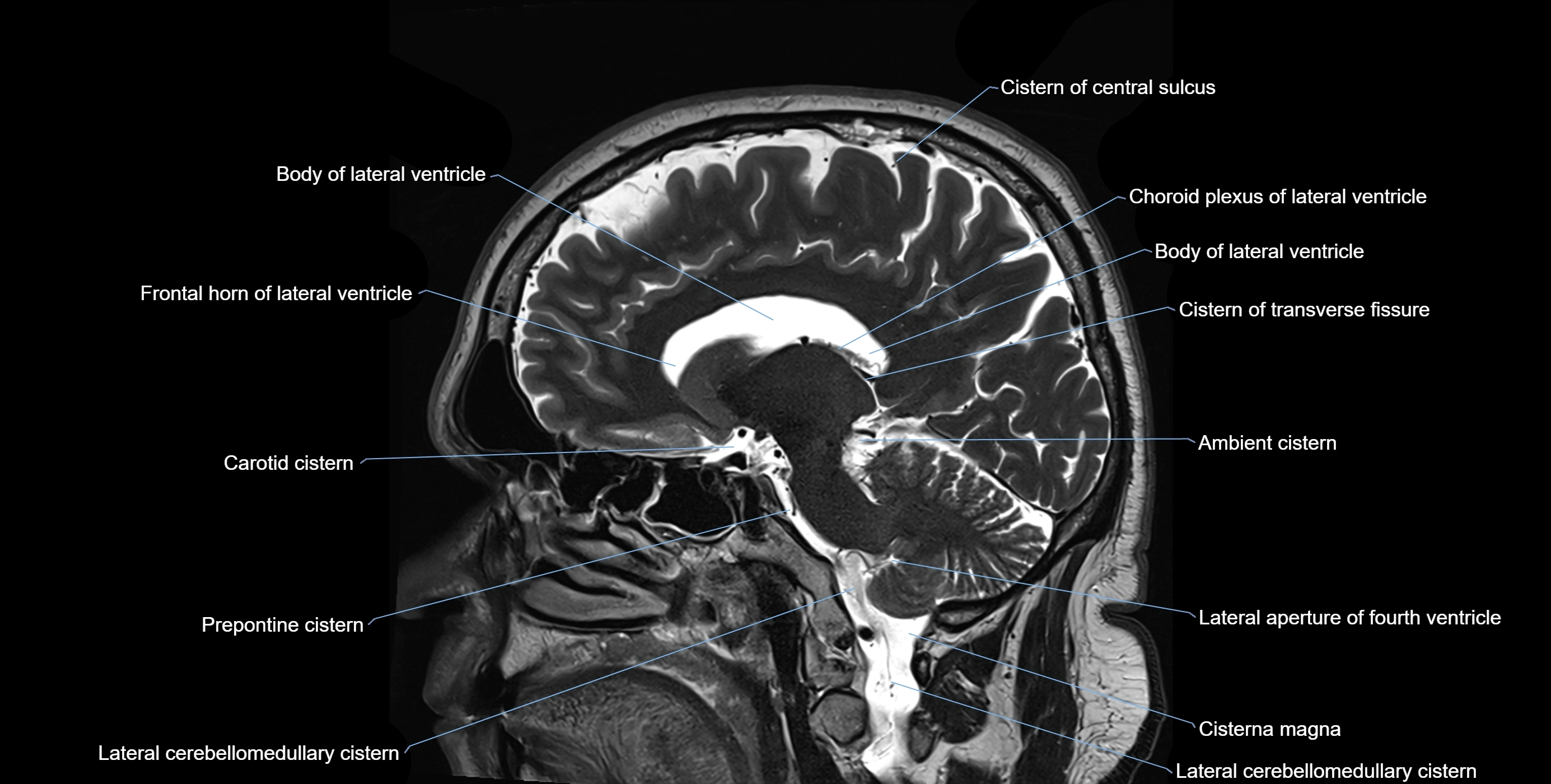 Brain cisterns  and ventricles sagittal anatomy 3T MRI image-img-00001-00034.webp